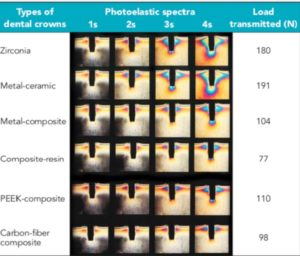 Trasmissione carico in tipi diversi di corone dentali