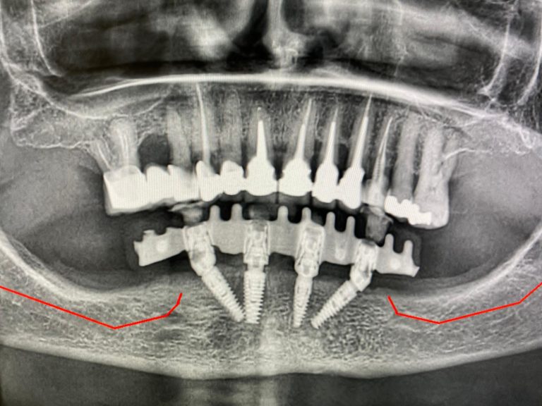 Sovraccarico masticatorio DP