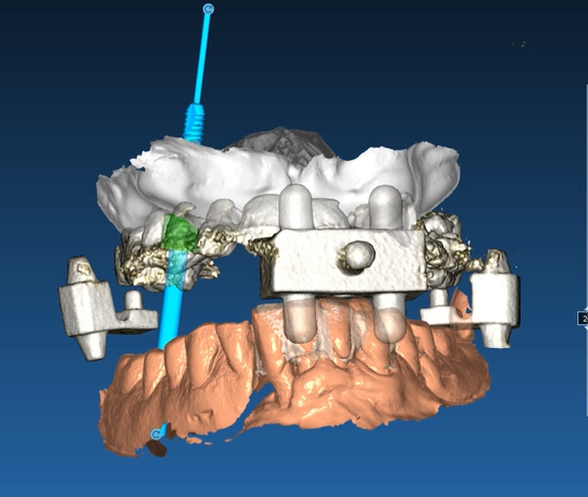 implantologia computer guidata dental point