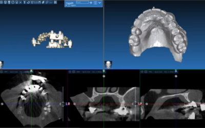 chirurgia computer guidata dental point