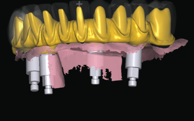 Implantologia computer guidata dental point srl