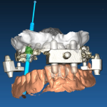 implantologia computer guidata dental point