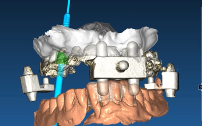 implantologia computer guidata dental point